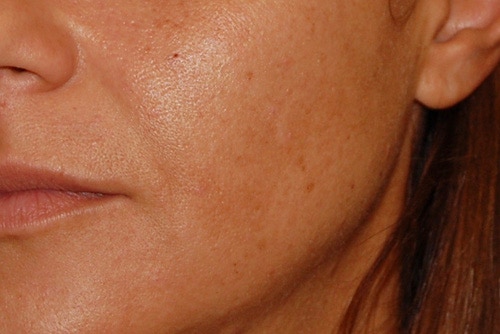 before Image